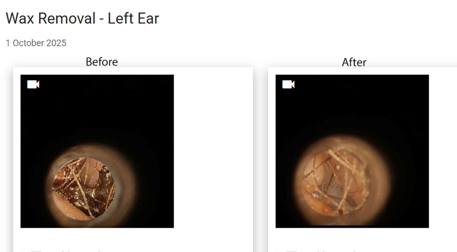 How best to treat water trapped in the ears, Surfer Ear, after water sports