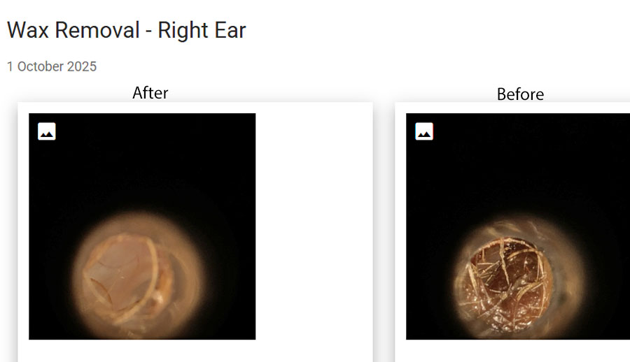 How best to treat water trapped in the ears, Surfer Ear, after water sports